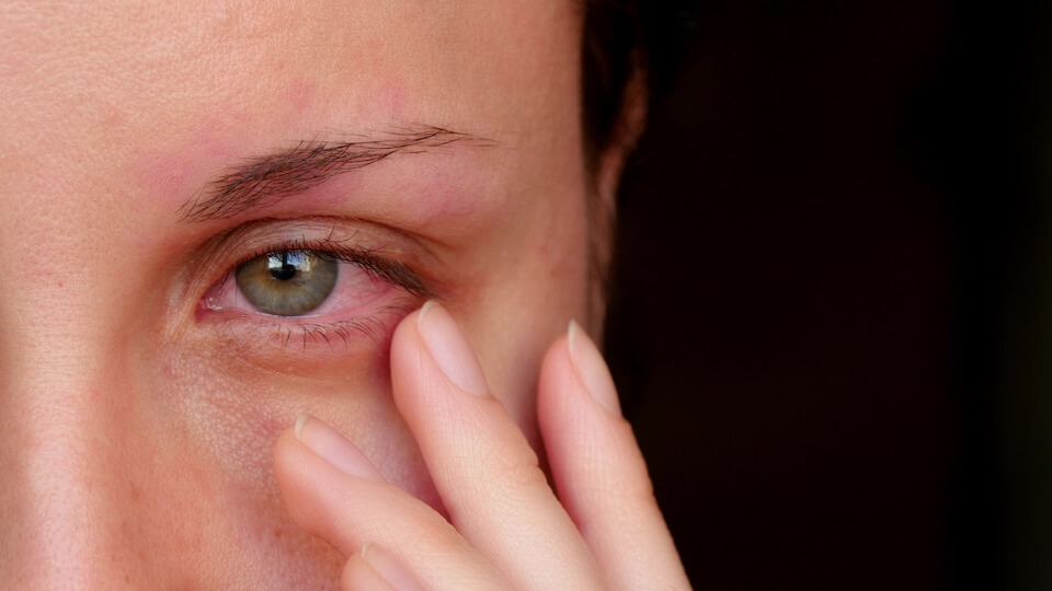 Øjenbetændelse: Når klistrer - Magasinet Helse